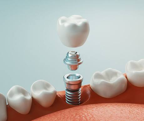 a 3D illustration of a dental implant and its parts
